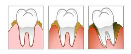 电动牙刷使用方法 电动牙刷使用注意事项2